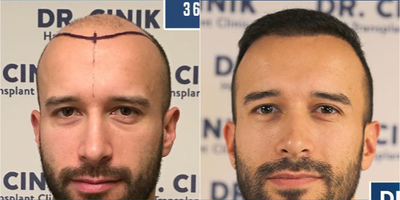 Man treated with Hair Loss Treatment - Man treated with Hair Loss Treatment. After 10 months