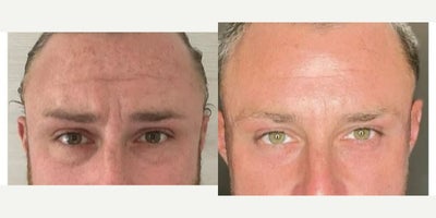 3544-year-old man treated with Botox, Micro Botox - Botox - treated by Aubrey H