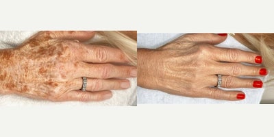 55-64 year old woman treated with Dermal Fillers, IPL, Hand Rejuvenation - Juvderm hand filler and IPL - treated by Aubrey H and Alyssa G