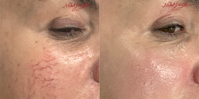 35-44 Years Old Woman Treated with Pulsed Dye Laser - As a result of Pulsed Dye Laser treatment, the new condition of the skin of our female patient, who had red veined spots on the cheek area; it is available in the appendix.
