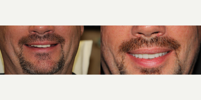 All-on-4 Dental Implants - All-on-4 Dental Implants