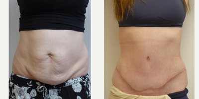 35-44 year old woman treated with Diastasis Recti Repair, Drainless Tummy Tuck - Staged surgery to first repair direct umbilical hernia, followed by full abdominoplasty and correction of 5cm diastasis (separation) of abdominal (rectus) muscles.
