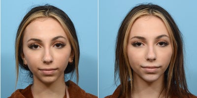 18-24 year old woman treated with Voluma - Chin filler