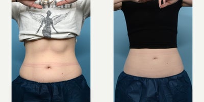 25-34 year old woman treated with Cryolipolysis - Looking for overall reduction of fat around her mid-section, this patient was treated with 2 CoolSculpting sessions for the lower abdomen and flanks, and 1 session for the upper abdomen. 3 months after her second session, she's thrilled with the results.