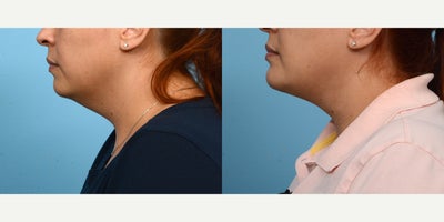 35-44 year old woman treated with Chin Surgery - A double chin and inadequate projection were the reasons this 37-year-old patient sought out Dr. Wise. Seven weeks after her combination chin implant/ submental liposuction surgery, she absolutely loves the definition and contour of her new jawline!