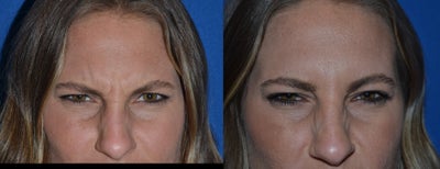 30 year old female seeking improvement of frown lines - 
	Treatment of frown lines between her eyebrows with the latest Botox like product called Xeomin. Excellent results with softening between her eyebrows, no more frown lines, and a more inviting appearance. No down time.
