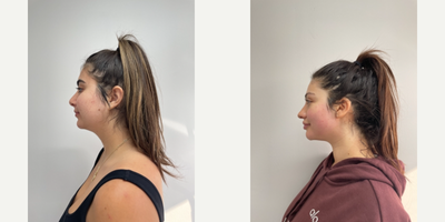 18-24 year old woman treated with Forma - 23 year old wanting to lift, tighten, and tone lower face and neck. Biggest concern was fat under chin.