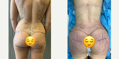 25-34 year old woman treated with Brazilian Butt Lift - BBL