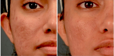 18-24 year old woman treated with Venus Viva - Venus Viva fractional radiofrequency/RF treatment is fantastic for facial resurfacing (wrinkles, sun spots, crepe skin, fine lines, pore reduction, and texture improvements), scars, and melasma. Since it is not a laser it can be used on all skin types (including darker skin and sensitive skin like those with eczema and/or rosacea). It is also fantastic for acne, as it helps the topical medications used to treat acne to penetrate the skin more readily. Long term tightening and lifting is improved with Venus Viva in combination with other skin tightening procedures such as radiofrequency/RF like Venus Legacy or ultrasound like Ultherapy.