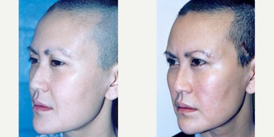 Woman treated with Thread Lift - Woman treated with Cheek Lift and Thread Lift