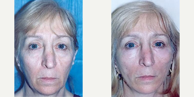 Woman treated with Thread Lift - Woman treated with Cheek Lift and Thread Lift