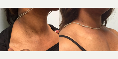 Skin tag removal with Aerolase laser - Results are seen here after one treatment with Aerolase laser. This treatment successfully removed her skin tags without any side effects such as skin pigmentation or the need for multiple office visits.