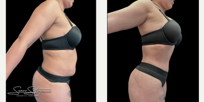 26 year old female treated with VASER Liposuction, Renuvion J Plasma Skin Tightening and post-operative lymphatic massages - 26 year old female who underwent VASER assisted liposculpting and Renuvion J plasma skin tightening of the abdomen, flanks, axilla, upper/middle/lower back; fat grafting to the buttocks and lateral hips (Brazilian Buttock Lift, BBL). Patient underwent 6 post-operative lymphatic massages.