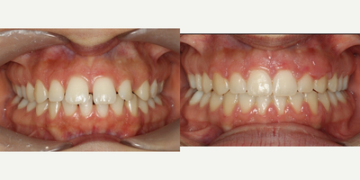 18-24 year old woman treated with Damon Braces - Female patient presented with generalized spacing. Treated with Damon braces for 6 mons to close all spaces.