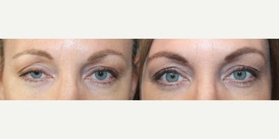 35-44 year old woman treated with Ptosis Surgery - ptosis repair to lift her droopy eyelid