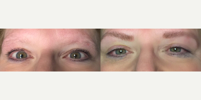 Woman treated with Microblading - Woman treated with Microblading