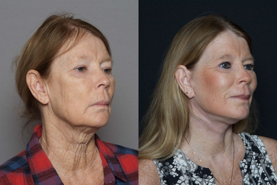 Woman over 60 years old treated with Laser Resurfacing - Woman over 60 years old treated with Laser Resurfacing
