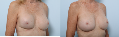 Strattice - Bilateral Breast Implant Exchange with Strattice