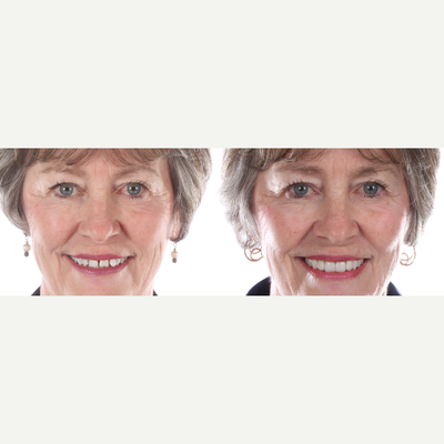 Lumineers porcelain veneers - Female Patient was unsatisfied with the spaces in between her teeth and existing shade. We placed 10 porcelain veneers to improve her smile.