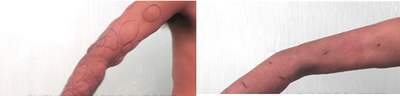 25-34 year old man treated with Lipoma Removal - The results of this client were significantly appreciable immediately post procedure.