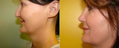 Rhinoplasty - Female shown before and after rhinoplasty with peri-pyriform implant.
