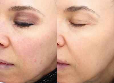 35-44 year old woman treated with Halo Laser - Before and After one treatment HALO