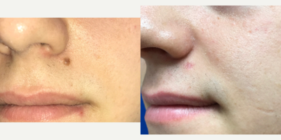 18-24 year old man treated with Mole Removal - Star Lux laser used to remove mole on this young man's face.