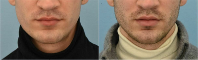 Man treated with Vollure - Man treated with Vollure.
