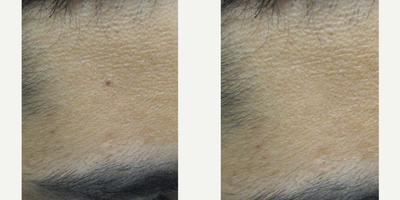 35-44 year old man treated with Sclerotherapy - 39-year-old Indian male with right lateral forehead laser mole removal before and after 5 laser treatments. Patient was very happy with the complete removal of his mole without surgery and without any evidence of scarring.