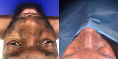25-34 year old man treated with African American Rhinoplasty - Photos of our patient on the surgical table right after the surgery