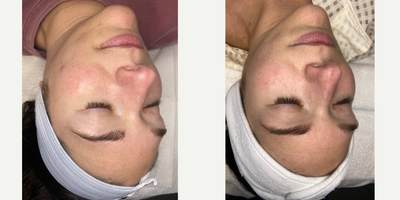 25-34 year old woman treated with Microneedling, SkinPen, HydraFacial, Dermaplaning, Facial - We prescribed this patient a customized ZO Skin Health protocol AM and PM. This patient noticed drastic redness reduction, strengthened skin barrier, and less dullness. We will continue her treatment plan with HydraFacial, Dermaplane, and a SkinPen microneedling series.