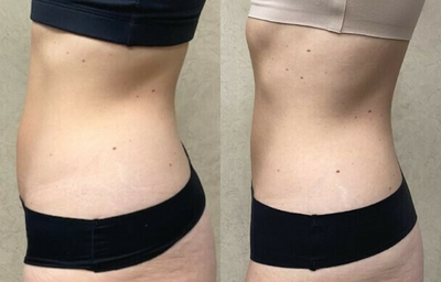 Woman treated with Evolve - Woman treated with Evolve