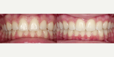 25-34 year old man treated with InBrace - This patient was treated over a 9 month period using InBrace, hidden behind the teeth, to straighten crowding.