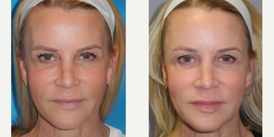 45-54 year old woman treated with RHA Collection Fillers to the temples - As the face ages, the temples can hallow out. Women had RHA filler to the temples to give a more youthful appearance.