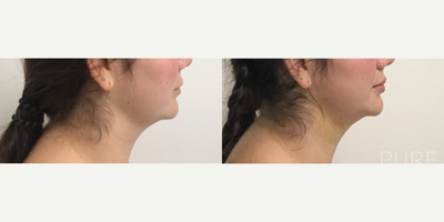 Woman treated with FaceTite - Woman treated with Chin Liposuction with FaceTite.Patient is shown before and 6 weeks post-op.