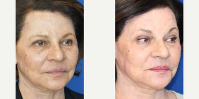 Woman treated with IPL - Woman treated with IPL