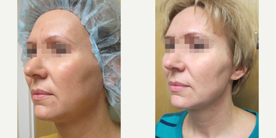 45-54 year old woman treated with Non Surgical Face Lift - Ultherapy treatment face and neck 3 months after treatment 42 yo
female