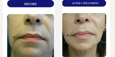45-54 year old woman treated with Fractora RF, Forma, Facial, Skin Tightening, Skin Rejuvenation - FRACTORA FIRM-FORMAbipolar radiofrequency
