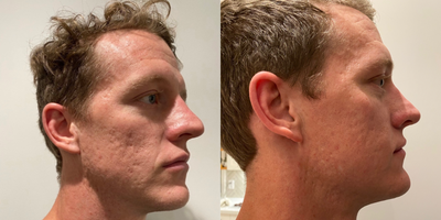 25-34 year old man treated with Microneedling - In response to highly sought after, minimally invasive treatments, VIRTUE RF allows patients to combat the fine lines and wrinkles that have set in, in addition to unwanted scars, including acne. With virtually zero downtime, our team of aesthetic experts, coupled with the most advanced RF Microneedling platform available, youll enjoy filter free and make-up free photos in short order. A VIRTUE RF treatment is virtually painless and made even more comfortable as you will be numbed with a topical anesthetic for 30-45 minutes prior to your treatment. For optimal results, we recommend three treatments spaced one month apart.