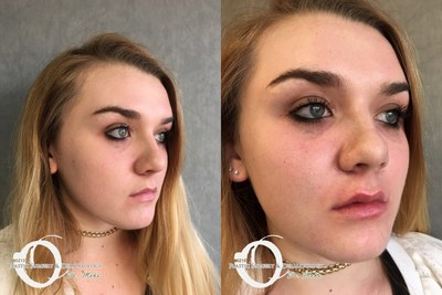 18-24 year old woman treated with Juvederm lip augmentation - Juvederm lips natural results 1/2 cc only