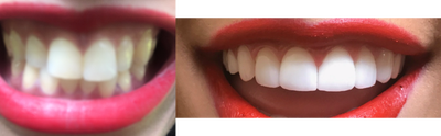 22 year old woman treated with 16 Porcelain Veneers - Patient complained of bunny teeth. This was how she described her two front teeth on the top. Her bunny teeth made her self-conscious about smiling or expressing herself fully in public settings. So, this patient decided to get 16 veneers (8 upper and 8 lower veneers) done by Dr. Thompson. Two visits later, she has perfectly straight, permanently white teeth and no bunny teeth.