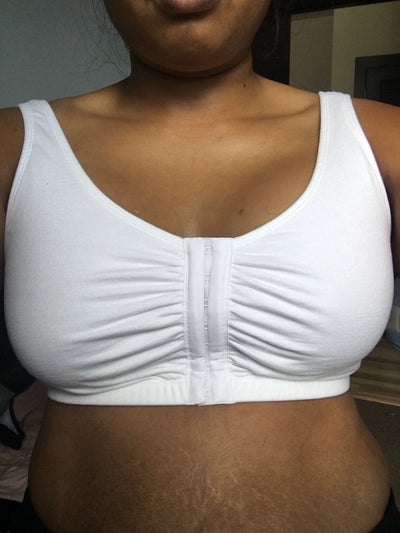 5'5” 146lbs 34A wanting a full D cup (455cc Ideal Implant) - Rev