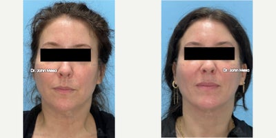 35-44 year old woman treated with Extended Chin Liposuction, Mini FaceTite, NeckTite - 35-44 year old woman treated with Extended Chin Liposuction, Mini FaceTite, NeckTite