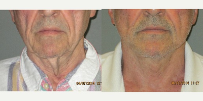 70+ year old man treated with Neck Lift - This gentleman presented for treatment of what he described as his turkey neck.  He had lost his profile years ago due to significant weight loss and health problems.  Based on his history we were able to comfortably perform a natural-appearing Neck Lift under local anesthesia (no general or IV) in our office.  The patient only required mild oral sedation with valium in order to proceed with relaxation and comfort.