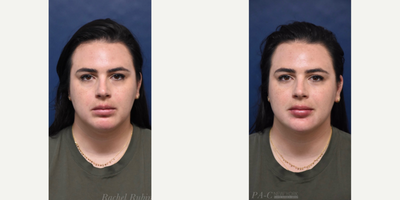 25-34 year old woman treated with Lip Fillers, Restylane Refyne, Juvederm, Restylane, Dermal Fillers, Volbella, Voluma, Restylan - A woman in her 30s, after the injection of Juvederm and RHA3 into the upper and lower lips. She also underwent chin filler in order to decrease shadowing around the mouth, improve contour and projection.