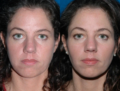 Buccal Fat Removal - 	Buccal fat pad removal and re-injection of fat to upper cheeks produces a slightly sculpted and thinner look to the face