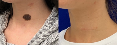19 year old woman treated with Mole Removal - 19 year old woman treated with Mole Removal