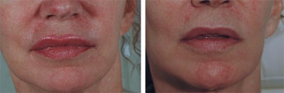 Permanent Makeup Removal Before and After Photos - 
	Before and after 3 treatments. Very similar to tattoo removal with q-switched lasers.
