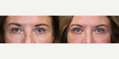Upper Lid Ptosis Repair - Brow lift, fat transfer, laser