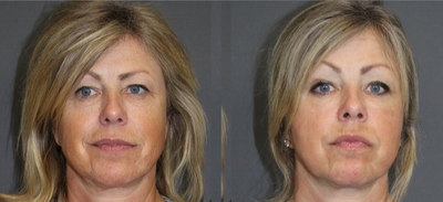 Pearl Fractional Laser - Full Face Pearl Fractional LaserHelped to reduce fine lines and wrinkles